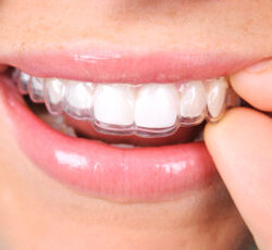 invisalign-orthodontics Saint Jerome